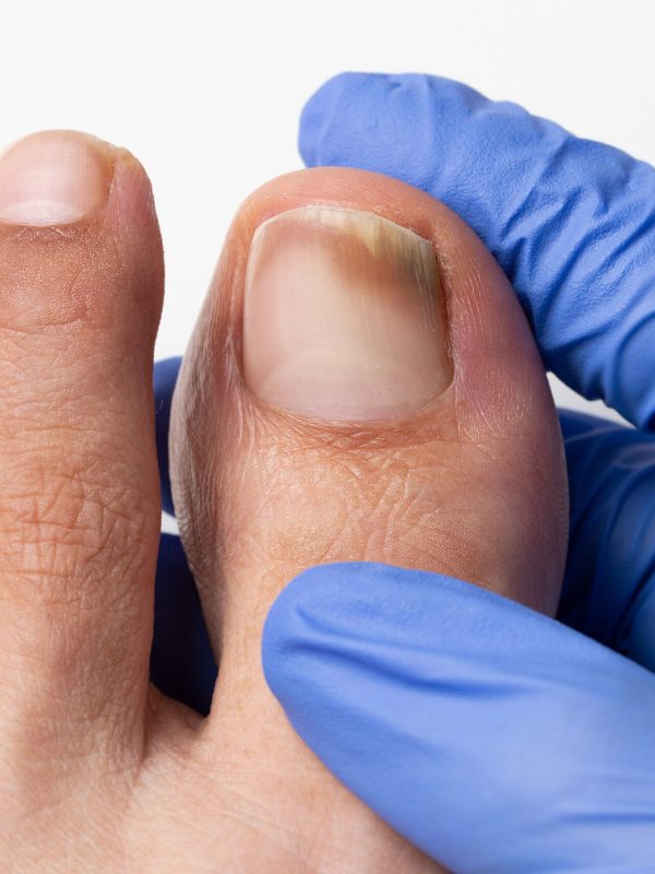 Close-up image of the doctor who controls the left toe that suffers a fungus nail